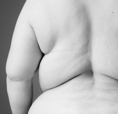Pablo Linde: La incierta revolución contra la obesidad